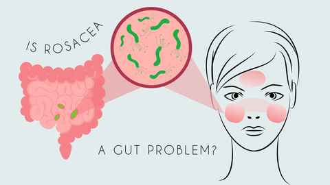 Is Rosacea a Gut Problem?